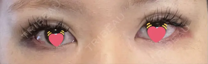 二重埋没 神戸元町ビューティークリニック DAY 2 メイン用