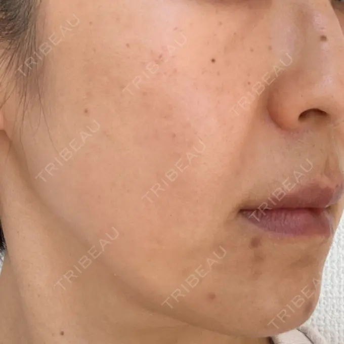 シミ取りレーザー 上本町皮フ科クリニック DAY 0 メイン用