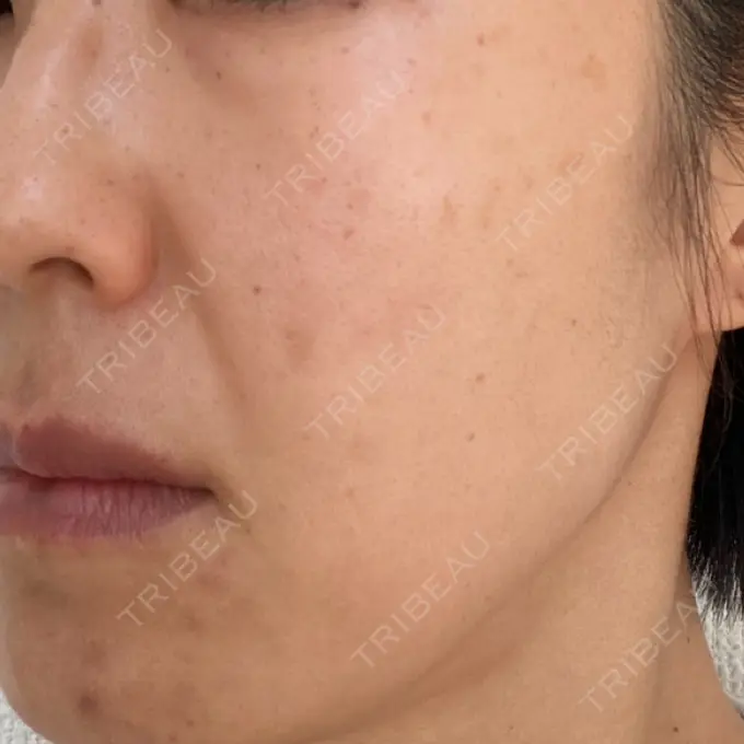 シミ取りレーザー 上本町皮フ科クリニック DAY 0 メイン用