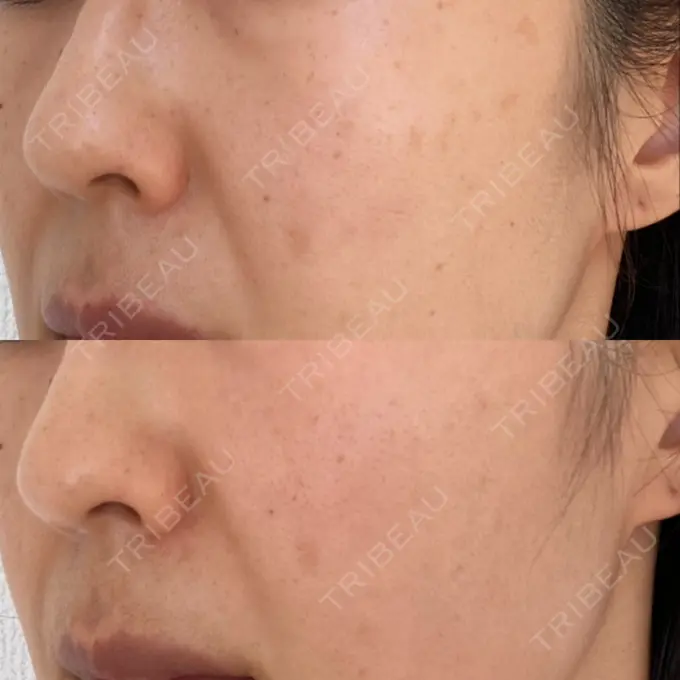 シミ取りレーザー 上本町皮フ科クリニック DAY 19 メイン用