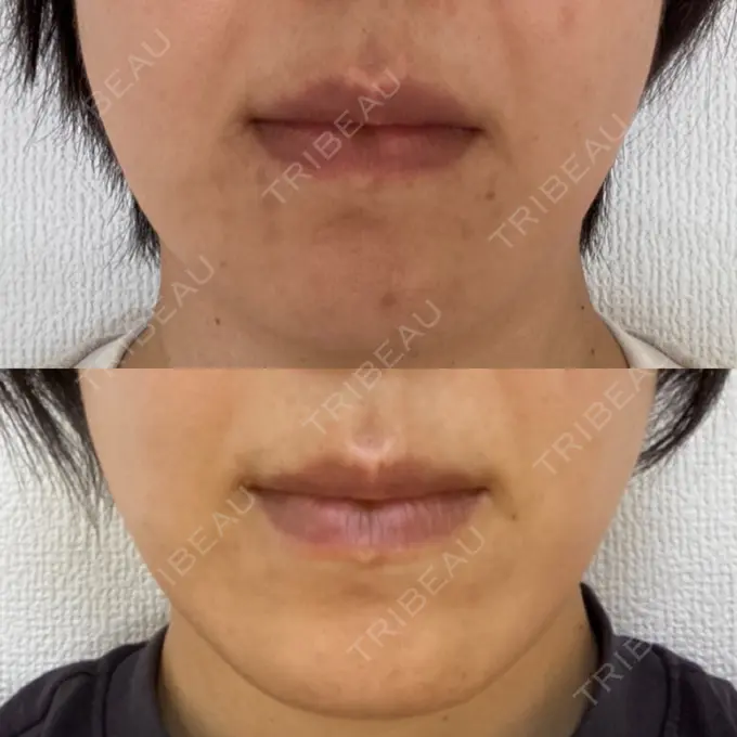 シミ取りレーザー 上本町皮フ科クリニック AFTER メイン用