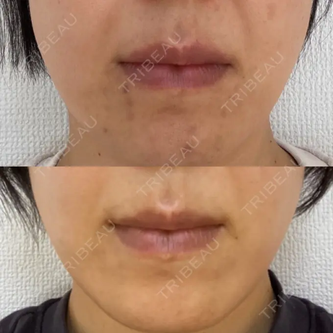 シミ取りレーザー 上本町皮フ科クリニック DAY 107 メイン用