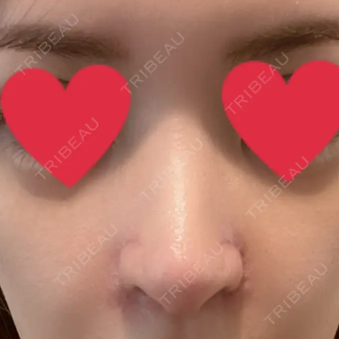 鼻中隔延長（切開） / 小鼻縮小（切開） / 脂肪吸引（お腹） / 軟骨移植 / 骨切幅寄せ / 鼻修正 / 鼻尖縮小 / 鼻翼基部形成（貴族手術） ヴェリテクリニック 大阪院 DAY 23 メイン用