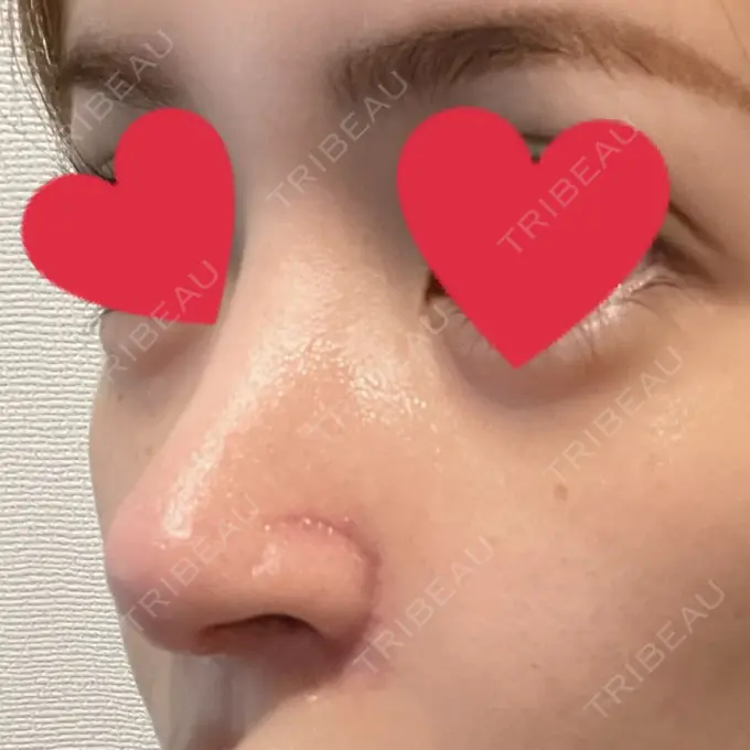 鼻中隔延長（切開） / 小鼻縮小（切開） / 脂肪吸引（お腹） / 軟骨移植 / 骨切幅寄せ / 鼻修正 / 鼻尖縮小 / 鼻翼基部形成（貴族手術） ヴェリテクリニック 大阪院 DAY 23 メイン用