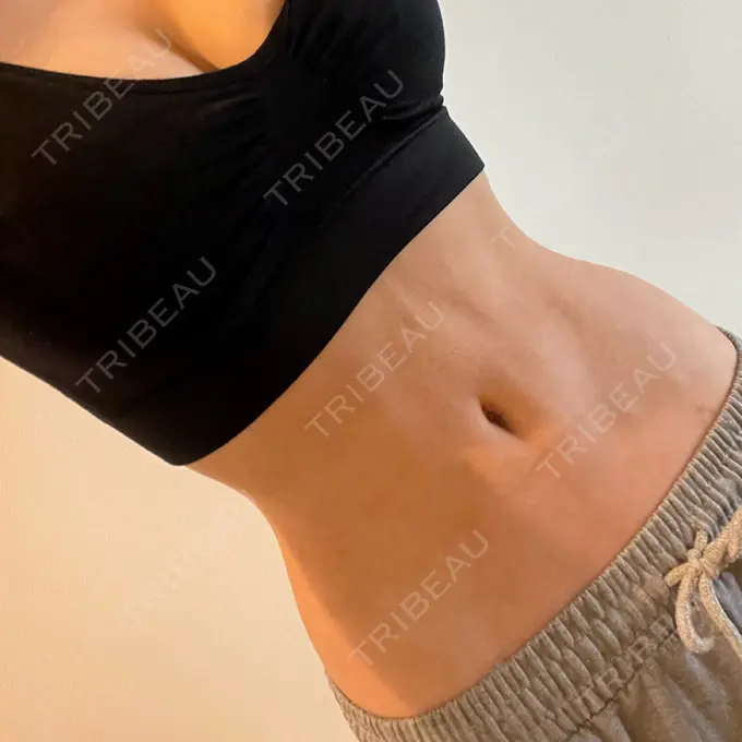 鼻中隔延長（切開） / 小鼻縮小（切開） / 脂肪吸引（お腹） / 軟骨移植 / 骨切幅寄せ / 鼻修正 / 鼻尖縮小 / 鼻翼基部形成（貴族手術） ヴェリテクリニック 大阪院 AFTER メイン用