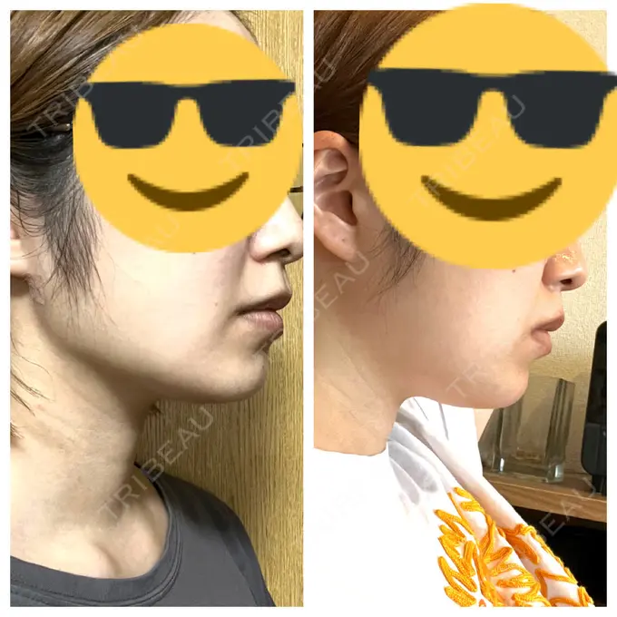 糸リフト / 脂肪吸引（顔） 東京シンデレラ美容外科 池袋院 DAY 20 メイン用