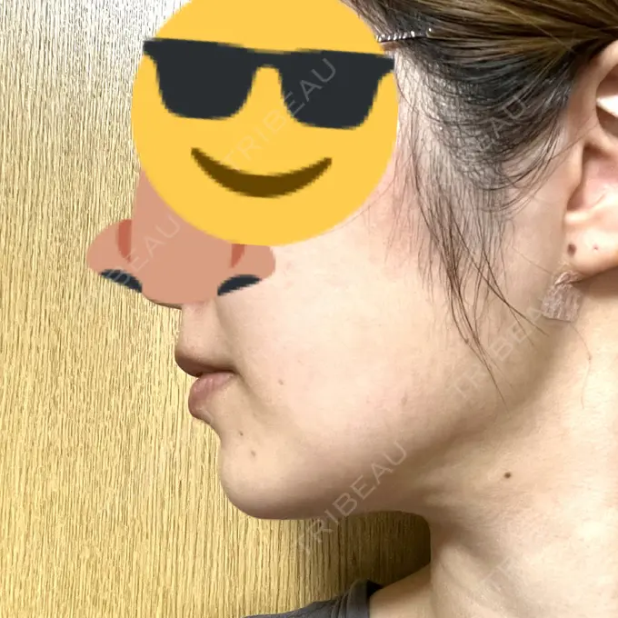 糸リフト / 脂肪吸引（顔） 東京シンデレラ美容外科 池袋院 DAY 20 メイン用