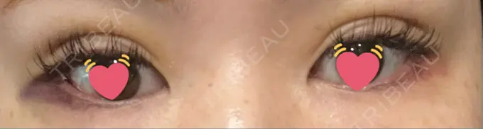 二重埋没 神戸元町ビューティークリニック DAY 3 メイン用