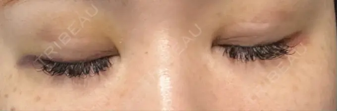 二重埋没 神戸元町ビューティークリニック DAY 3 メイン用