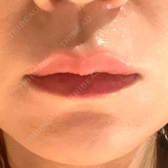 ボトックス（人中） veary clinic DAY 1 メイン用