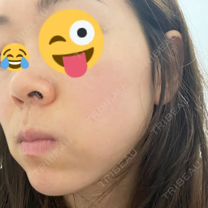 美肌レーザー まゆりなclinic 名古屋栄 DAY 3 メイン用