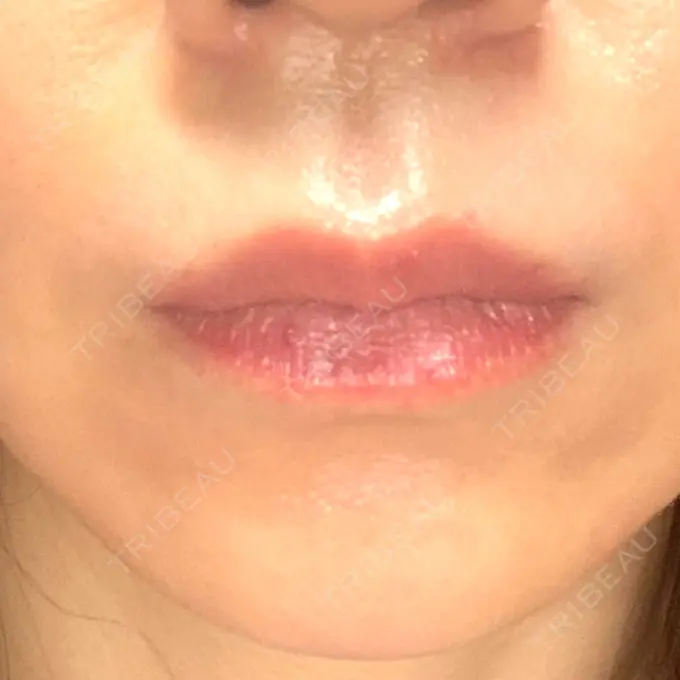 ボトックス（人中） veary clinic AFTER メイン用