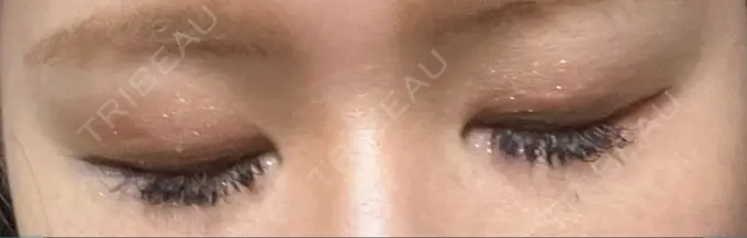 二重埋没 神戸元町ビューティークリニック DAY 5 メイン用