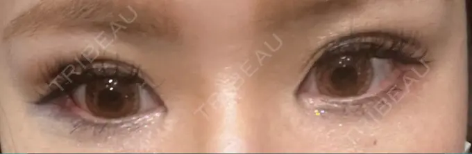 二重埋没 神戸元町ビューティークリニック DAY 5 メイン用