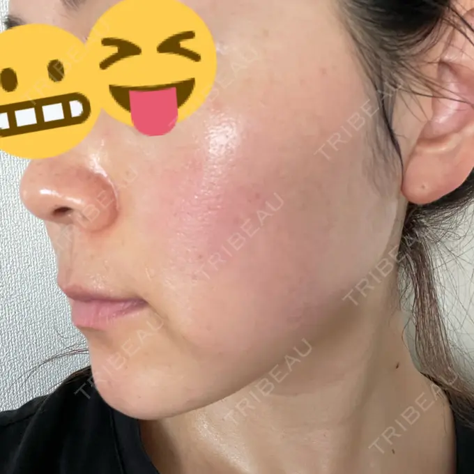 美肌レーザー まゆりなclinic 名古屋栄 DAY 4 メイン用