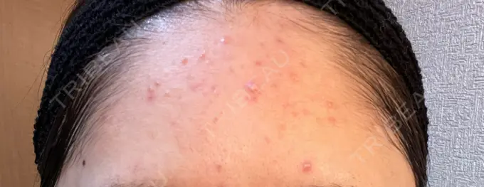 ピーリング（ニキビ・毛穴） / イオン導入 渋谷美容外科クリニック 横浜院 DAY 10 メイン用