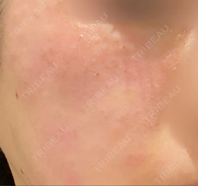 ピコスポット Fellez Clinic【フェルズクリニック】 DAY 0 メイン用