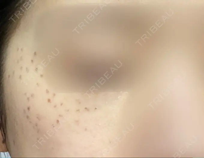 ピコスポット Fellez Clinic【フェルズクリニック】 DAY 4 メイン用