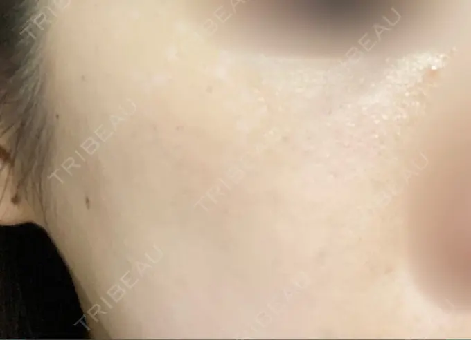 ピコスポット Fellez Clinic【フェルズクリニック】 AFTER メイン用