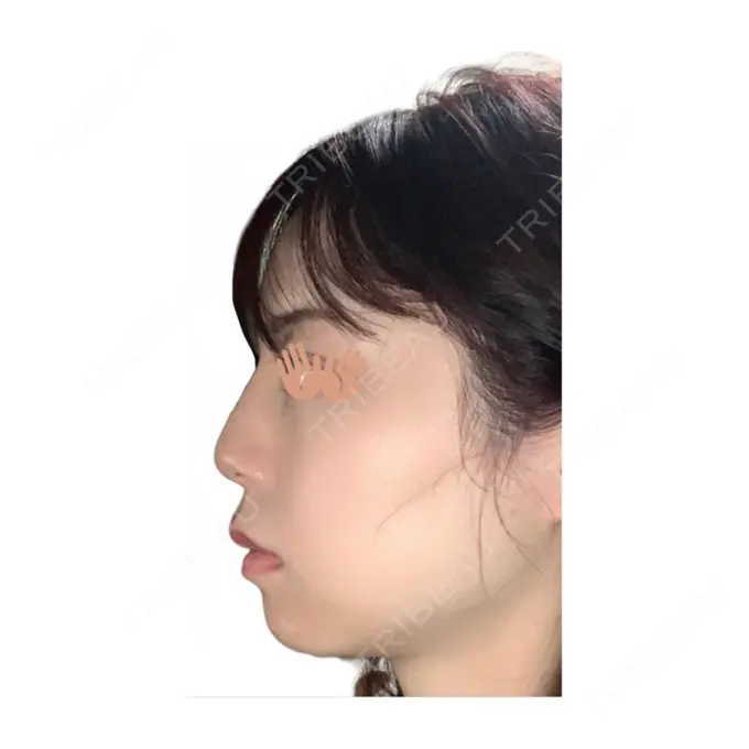 ヒアルロン酸注入（鼻） STARS CLINIC DAY 0 メイン用