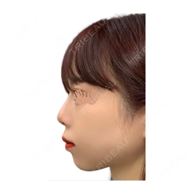 ヒアルロン酸注入（鼻） STARS CLINIC AFTER メイン用