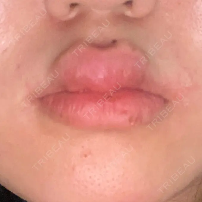 ヒアルロン酸注入（唇） / ボトックス（口角） フィラークリニック 町田院 DAY 0 メイン用