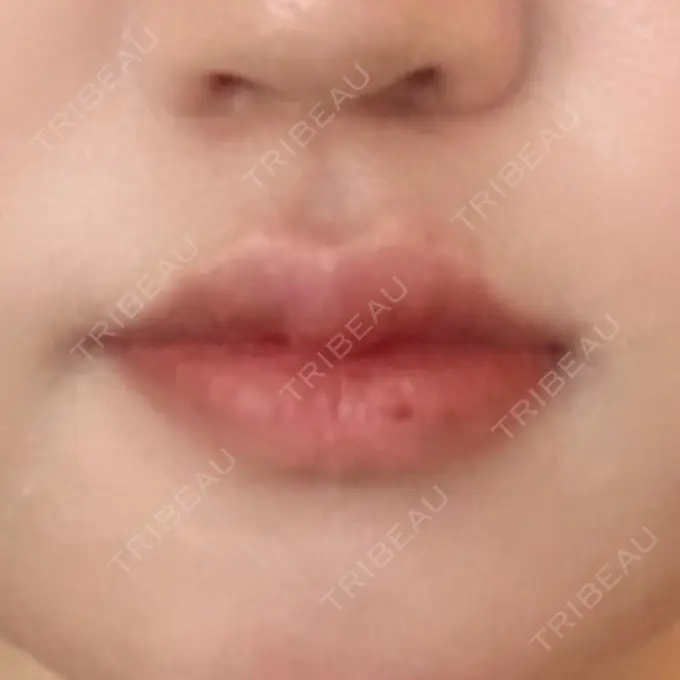 ヒアルロン酸注入（唇） / ボトックス（口角） フィラークリニック 町田院 DAY 1 メイン用