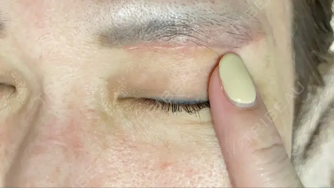 上まぶたたるみ取り 心斎橋形成外科スキンケアクリニック AFTER メイン用