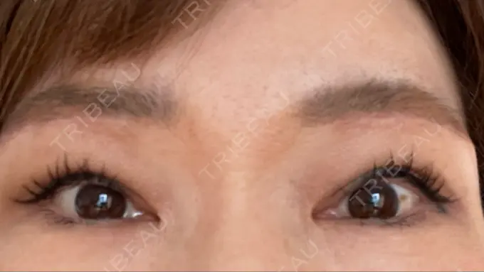 上まぶたたるみ取り 心斎橋形成外科スキンケアクリニック DAY 17 メイン用