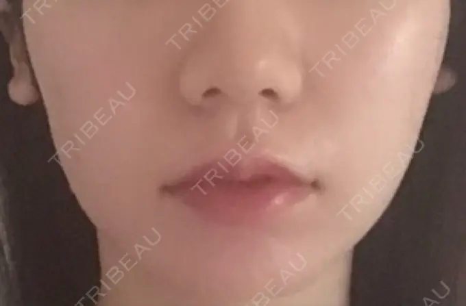 ハイフ（顔） メディアージュクリニック 青山院 AFTER メイン用