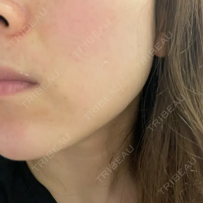 美肌レーザー まゆりなclinic 名古屋栄 DAY 5 メイン用