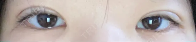 二重埋没 神戸元町ビューティークリニック DAY 1 メイン用