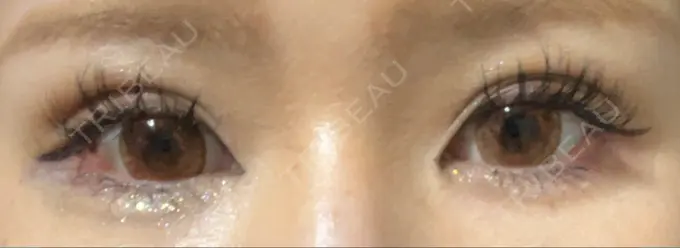 二重埋没 神戸元町ビューティークリニック DAY 7 メイン用