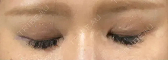 二重埋没 神戸元町ビューティークリニック DAY 7 メイン用