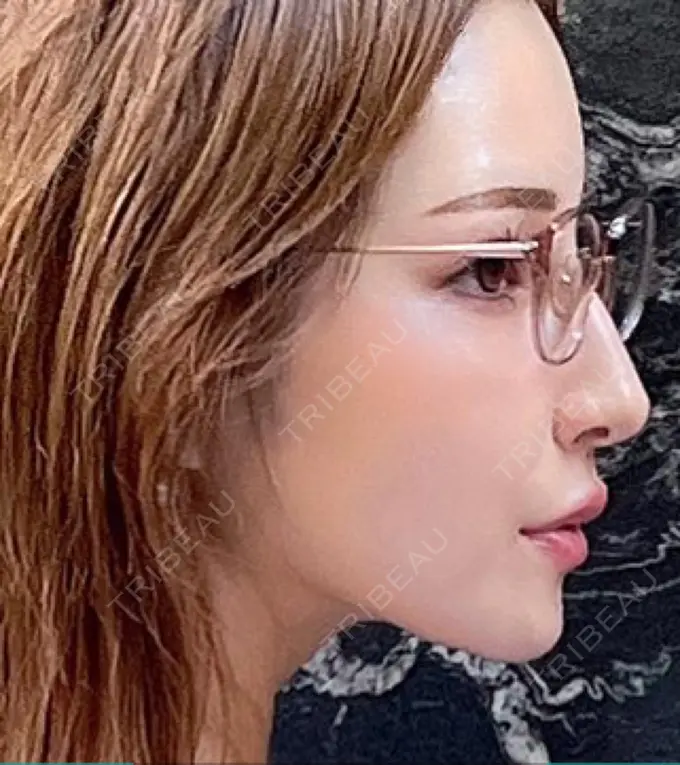 人中短縮 / ヒアルロン酸注入（唇） / ボトックス（口角） EMMO FACE CLINIC 大宮院 DAY 64 メイン用