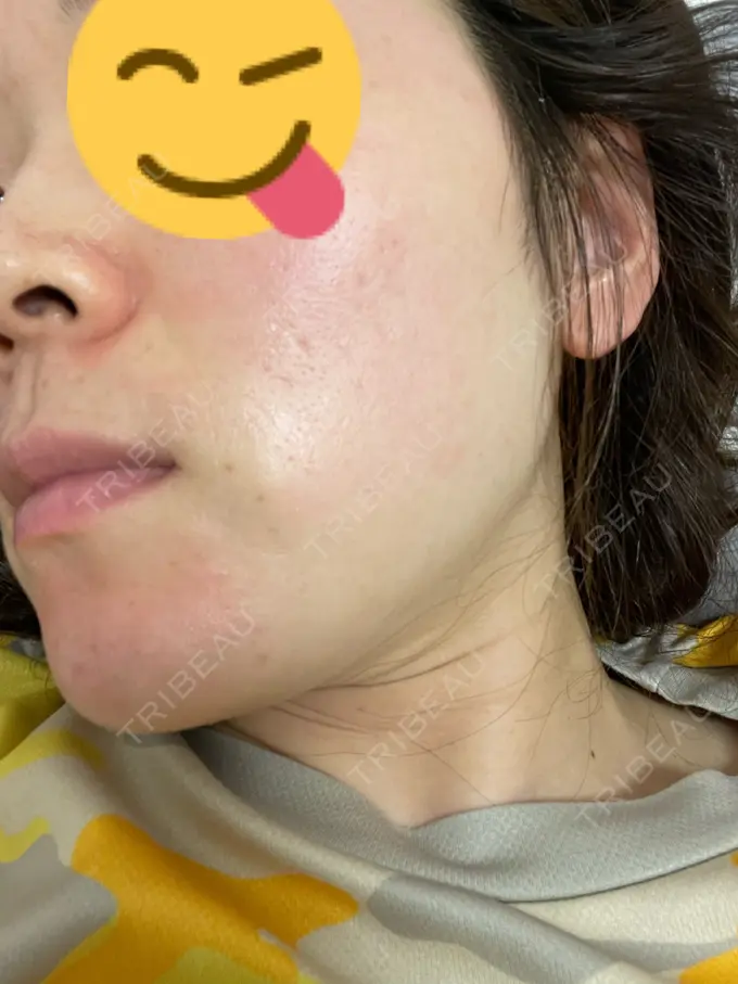 美肌レーザー まゆりなclinic 名古屋栄 DAY 6 メイン用