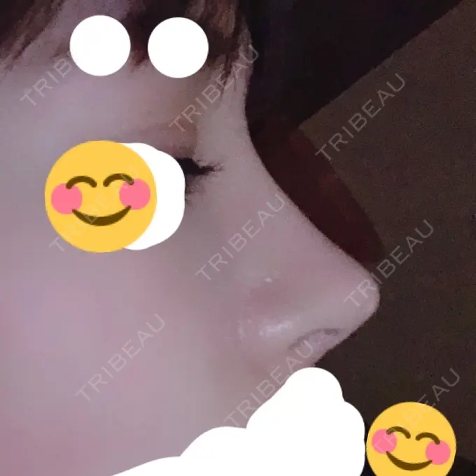 隆鼻術 / 軟骨移植 / プロテーゼ除去 FROM B整形外科 (旧バウム整形外科) DAY 222 メイン用