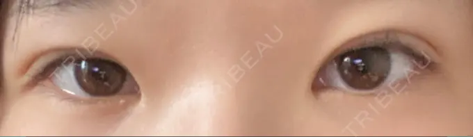 二重埋没 神戸元町ビューティークリニック DAY 2 メイン用