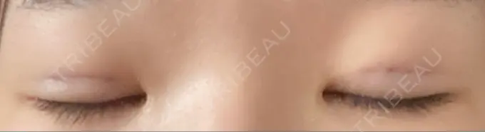 二重埋没 神戸元町ビューティークリニック DAY 2 メイン用