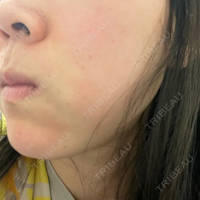 美肌レーザー まゆりなclinic 名古屋栄 DAY 7 メイン用