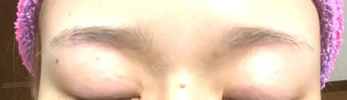 上まぶたの脂肪取り / 眉下切開 e:Top clinic（イートップクリニック） DAY 72 メイン用