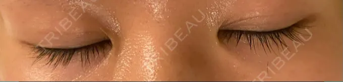 二重埋没 アマソラクリニック DAY 21 メイン用