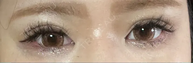 二重埋没 神戸元町ビューティークリニック AFTER メイン用