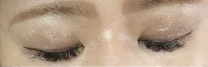 二重埋没 神戸元町ビューティークリニック DAY 9 メイン用