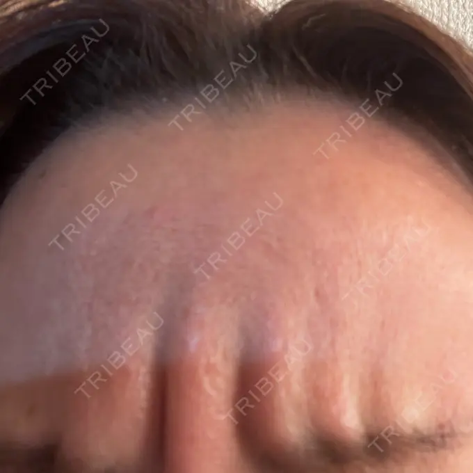 ボトックス（眉間） TCB東京中央美容外科 福岡天神院 DAY 3 メイン用