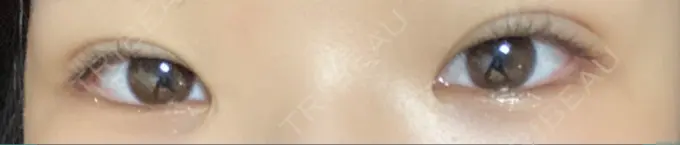 二重埋没 神戸元町ビューティークリニック DAY 3 メイン用