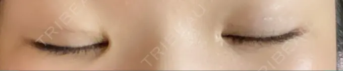 二重埋没 神戸元町ビューティークリニック DAY 3 メイン用