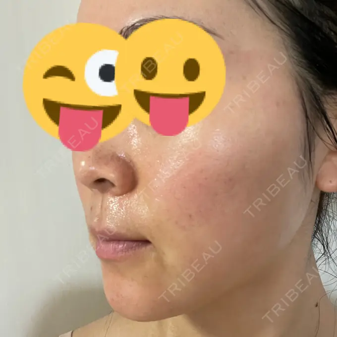 美肌レーザー まゆりなclinic 名古屋栄 DAY 8 メイン用