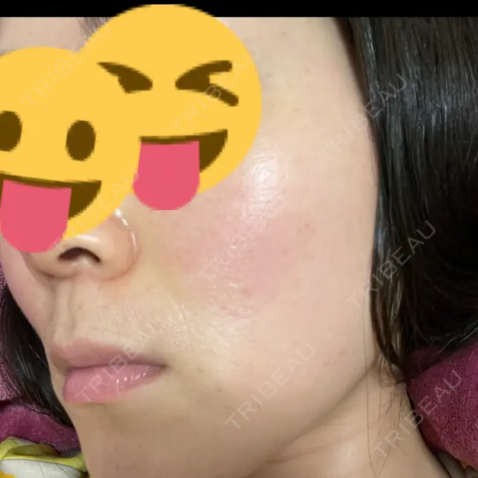 美肌レーザー まゆりなclinic 名古屋栄 DAY 9 メイン用