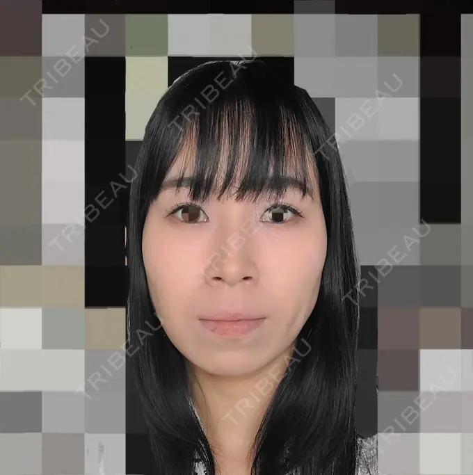 ハイフ（顔） オーキッド美容クリニック東京御徒町 DAY 7 メイン用